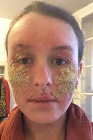 Image result for ekzema face