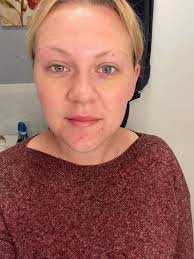 Not sure if it's been said before but the skin virus drops work wonders