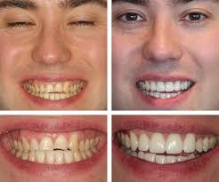 Thousands of dental professionals all over the world rely on us for our support of their bleaching services.simplicity for you and your patients is the goal that has guided the development of our product line. Ben Teeth Whitening And Veneers Before After Central London W1 Uk Harley Street Dental Studio