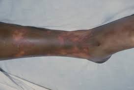 This infection can lead to meningitis, in which the bacteria invades the membranes of the. Meningiococcemia Menningococcemia Menningiococcemia Meningococcal Bacteremia Meningococcal Septicemia Dermatology Advisor