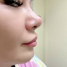 SALT LAKE CITY BOTOX AND FILLERS