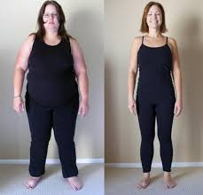Weight Loss Surgery In Albuquerque Bariatric Surgery Source