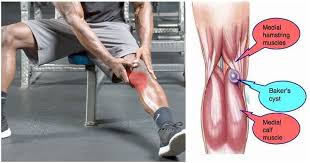 Is bump on leg behind knee from pulled muscle? Are You Experiencing Pain Behind The Knee Here Are 4 Possible Reasons For It Fitness And Power