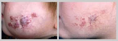 Hemangioom Da Vinci Clinic Daarom is het belangrijk om. hemangioom da vinci clinic