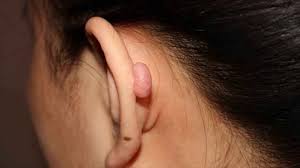 Telinga bengkak berisi cairan juga bisa disebabkan oleh infeksi telinga luar. Cara Menghilangkan Keloid Di Telinga Yang Efektif Lewat Tindakan Medis Kabar Tangsel