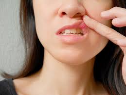 Image result for Canker sores symptoms roof of the mouth
