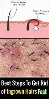 This works well especially on a looped ingrown hair. Best Steps To Get Rid Of Ingrown Hairs Fast Face Errors Ingrownhairs Hair Ingrown Ingrown Hair Hair Irritation Infected Ingrown Hair
