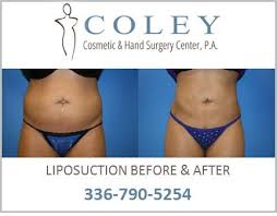 The cost of liposuction depends on the size of your abdominal area. Liposuction Greensboro Nc Liposuction Burlington Nc