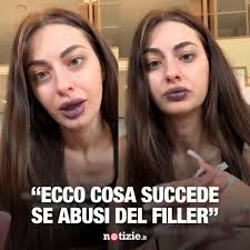 @roberryc spiega ai suoi followers cosa succede se si abusa del filler alle  labbra. La ragazza ha deciso di fare la ialuronidasi ed ecco il risultato.,  Cosa ne pensate?