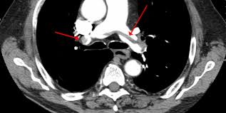 Medicare coverage includes a prescreening counseling visit with the health professional who wrote the order to review the benefits and risks of. Overuse Of Ct Scans For Suspected Pulmonary Embolism Persists Tctmd Com