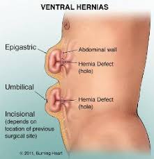 Incisional Hernia Medical Knowledge Medical Surgical Nursing Surgical Nursing