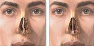 For others, a nose injury causes it. Deviated Septum Repair Septoplasty In Los Angeles California