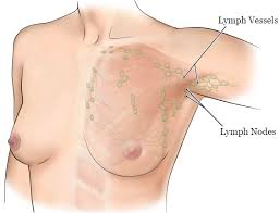 Image result for Mastectomy