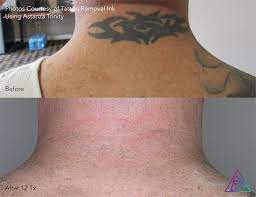 Removery is the largest and most trusted tattoo removal brand in north america. Laser Tattoo Removal Faq Minnesota Brow Lash Studio Academy