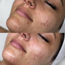 Discover your path to radiant skin with customized care! Our Platinum  Hydrafacial provides a deep cleanse and hydration for a luminous  complexion. #hydrafaci̇al #hydrafacials #oc #skincareroutine  #skincareproducts #skin #losangeles #clearskin ...