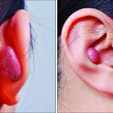 Pdf Common Complications After Auricular Piercing In Korea Case Reviews And Treatment