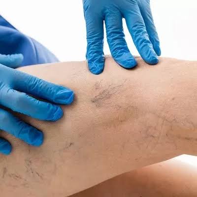 Sclerotherapy: Effective Spider Veins Treatment In Dubai & Abu Dhabi