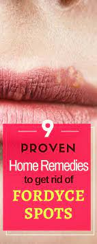 Fordyce's spots, also known as fordyce granules, fordyce's condition, and sebaceous prominence, are small, painless, pale bumps or spots 1 to 3 millimeters in diameter that may appear on the shaft it is possible however, to reduce the prominence of these spots, or even get rid of them completely. Learn To Get Rid Of Fordyce Spots Completely Naturally Using Home Remedies That Are Easy To Perform And Give Fordyce Natural Headache Remedies Natural Headache