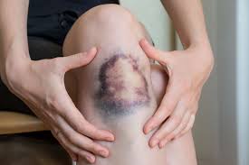 Large knee bruise being held by hands, illustrating easy bruising seen with some bleeding or clotting disorders