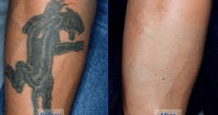 We are here to give you the facts and information you need on. 5 Natural Tattoo Removal Remedies You Can Try At Home Latest Ghanaian Health Fitness Beauty Trends Pulse Ghana