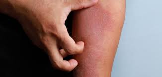 النظافة الصحية الفموية الحلق (الغرغرة) ، الأمراض الجلدية كمضاد للحكة(antipruriginous) ، و للتأثير على احتقان البواسير ومشاكل في الدورة الدموية الوريدية ( الدوالي ) في الأطراف السفلية. Ø§Ù„Ù†Ø¨Ø§ØªØ§Øª Ø§Ù„Ø³Ø§Ù…Ø© ÙŠÙ…ÙƒÙ† Ø§Ù† ØªØ¹ØªØ±Ø¶Ù†Ø§ ÙÙŠ Ø§ÙŠ Ù…ÙƒØ§Ù† ÙˆØ§ÙŠ ÙˆÙ‚Øª Ù„Ø°Ù„Ùƒ ØªØ¹Ø±ÙÙˆØ§ Ø¹Ù„ÙŠÙ‡Ø§ Ø§ÙƒØ«Ø± Ù…Ù† Ø®Ù„Ø§Ù„ Ù‡Ø°Ø§ Ø§Ù„Ù…Ù‚Ø§Ù„