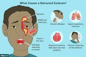 Retracted Ear Drum Causes, Symptoms, And Treatment