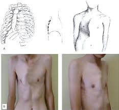 We did not find results for: Minimally Invasive Repair Of Pectus Carinatum The Annals Of Thoracic Surgery