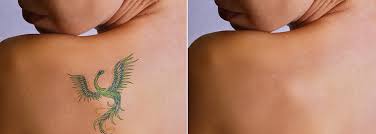 Oxnard, ca 93033 (map) program hours: Laser Tattoo Removal Sydney Best Tattoo Removal Treatment In Sydney
