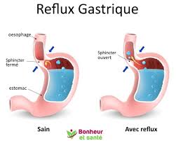 Par exemple, les infusions de camomille et de réglisse peuvent être utilisées. Les Meilleurs Remedes Naturels Contre Les Brulures D Estomac Bonheur Et Sante