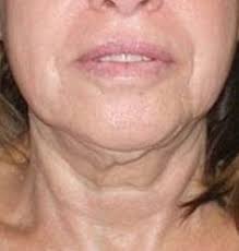 9 Best Eradicate Wattle On The Neck And Turkey Neck With Face Exercises Ideas Face Exercises Turkey Neck Natural Face Lift