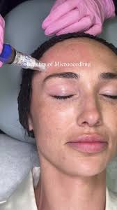 ✨ Transform your skin with microneedling at Shino Bay Cosmetic Dermatology  in Fort Lauderdale! This powerful treatment helps:, ✔ Smooth fine lines and  wrinkles, ✔ Improve acne scars and texture, ✔ ...