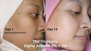Whatsapp or dm to purchase ig; The Ordinary Alpha Arbutin 2 Weeks Trial Youtube
