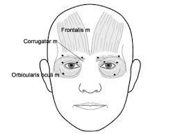 Injection Techniques With Botulinum Toxin In The Treatment