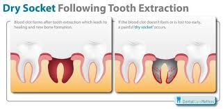 Luxuriant Wisdom Teeth Problems Oralhealthafrica Teethwhiteninghomemade Wisdom Tooth Extraction Tooth Extraction Wisdom Teeth