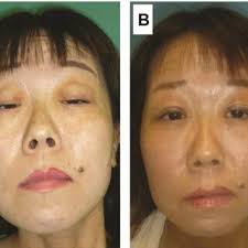 A ) Preoperative view of the patient with ptosis shows that she has a...