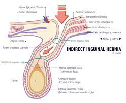 The hesselbach triangle, also called the inguinal triangle, is a region of the lower, anterior abdominal wall, or groin, that was first described by frank hesselbach, a german surgeon and anatomist, in 1806. Hernias Gastrointestinal Medbullets Step 1