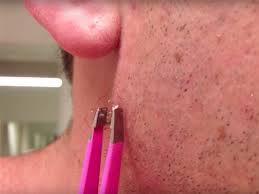 Usually, ingrown hair improves without treatment. Video The Most Watched Ingrown Hair Removal On Youtube