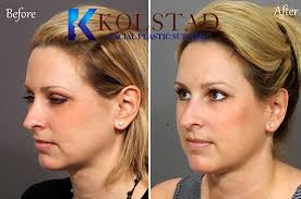 Check out before/after pictures to see for yourself & get free shipping on all orders. Cheek Fillers Smile Line Fillers Results Dr Kolstad San Diego Facial Plastic Surgeon