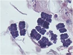 Only 22 cases of human infections by this microorganism. Gastric Sarcina Organisms In A Patient With Cystic Fibrosis Sciencedirect