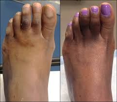 Corn Blast Remover Coffeescrubbenefits Corn On Toe Nail Care Routine Effective Skin Care Routine