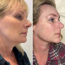 Fat Dissolving Treatments in Kent