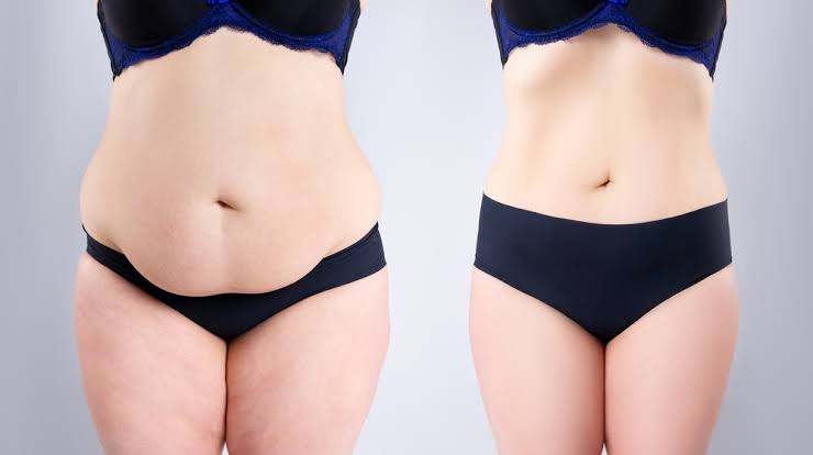 From Start to Finish: How Long Does a Tummy Tuck Take? | Legacy
