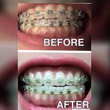 And also visiting a dentist, taking the advanced treatments for whitening of teeth with braces is more expensive. Pin On Helen S Beauty Box