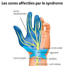 Au banc des accusés : Le Syndrome Du Canal Carpien Quels Sont Les Symptomes