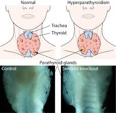 Image result for Hyperparathyroidism