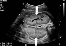 Echogenic Fetal Kidneys Differential Diagnosis And Postnatal Outcome Iame