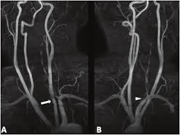Carotid artery dissection has been described after chiropractic manipulation. Mra Reveals Left Common Carotid Artery Dissection Arrow And Left Va Download Scientific Diagram