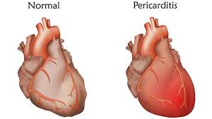 Existen múltiples causas de miocarditis, incluyendo infecciones virales, bacterianas o parasitarias, drogas (incluido el alcohol). Que Es La Pericarditis Sintomas Causas Y Como Tratar La Enfermedad