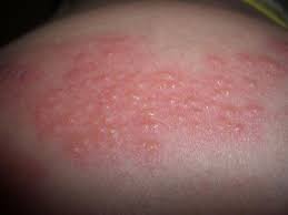 Typically the rash occurs in a single, wide stripe either on the left or right side of the body or face. Vaccin Ger Nytt Skydd Mot Baltros Sporthalsa