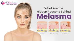 Image result for Melasma